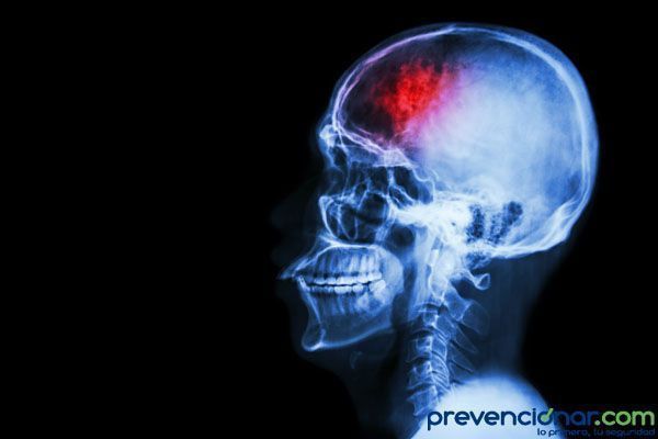 El estrés podría aumentar el riesgo de accidente cerebrovascular